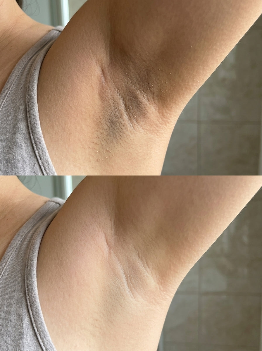 Antes e depois axila escura